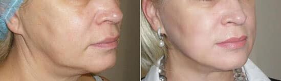 Photo après avoir appliqué la procédure