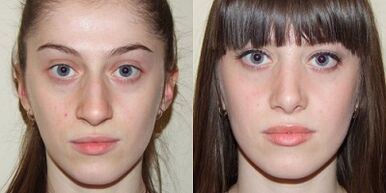Avant et après le rajeunissement de la peau au plasma.