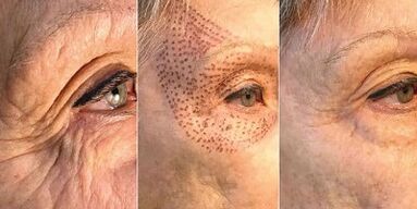 Photos avant et après le rajeunissement de la peau au plasma.